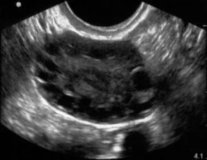 pcos ultrasound
