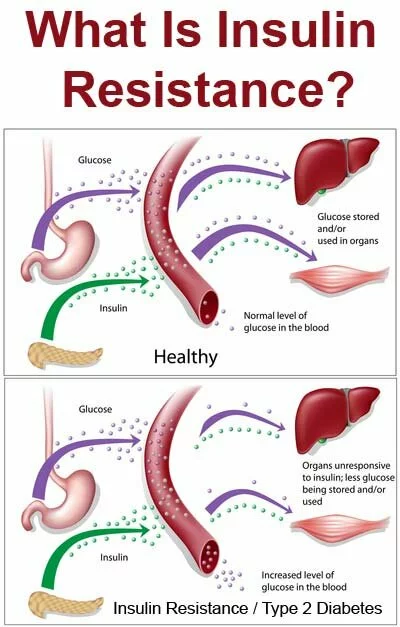 PCOS insuline resistance